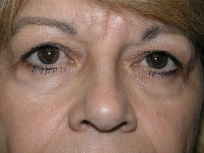 Blepharoplasty Before & After Patient #1499