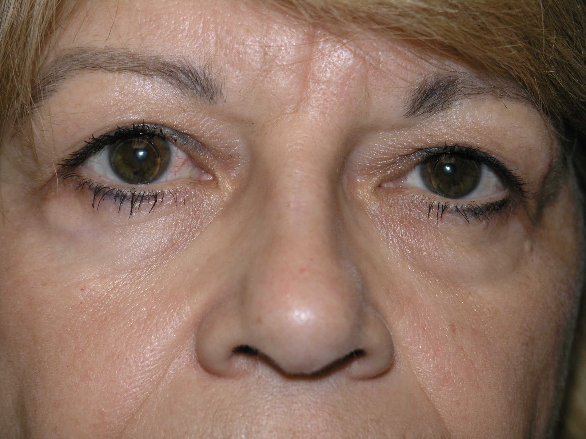 Blepharoplasty Before & After Patient #1499