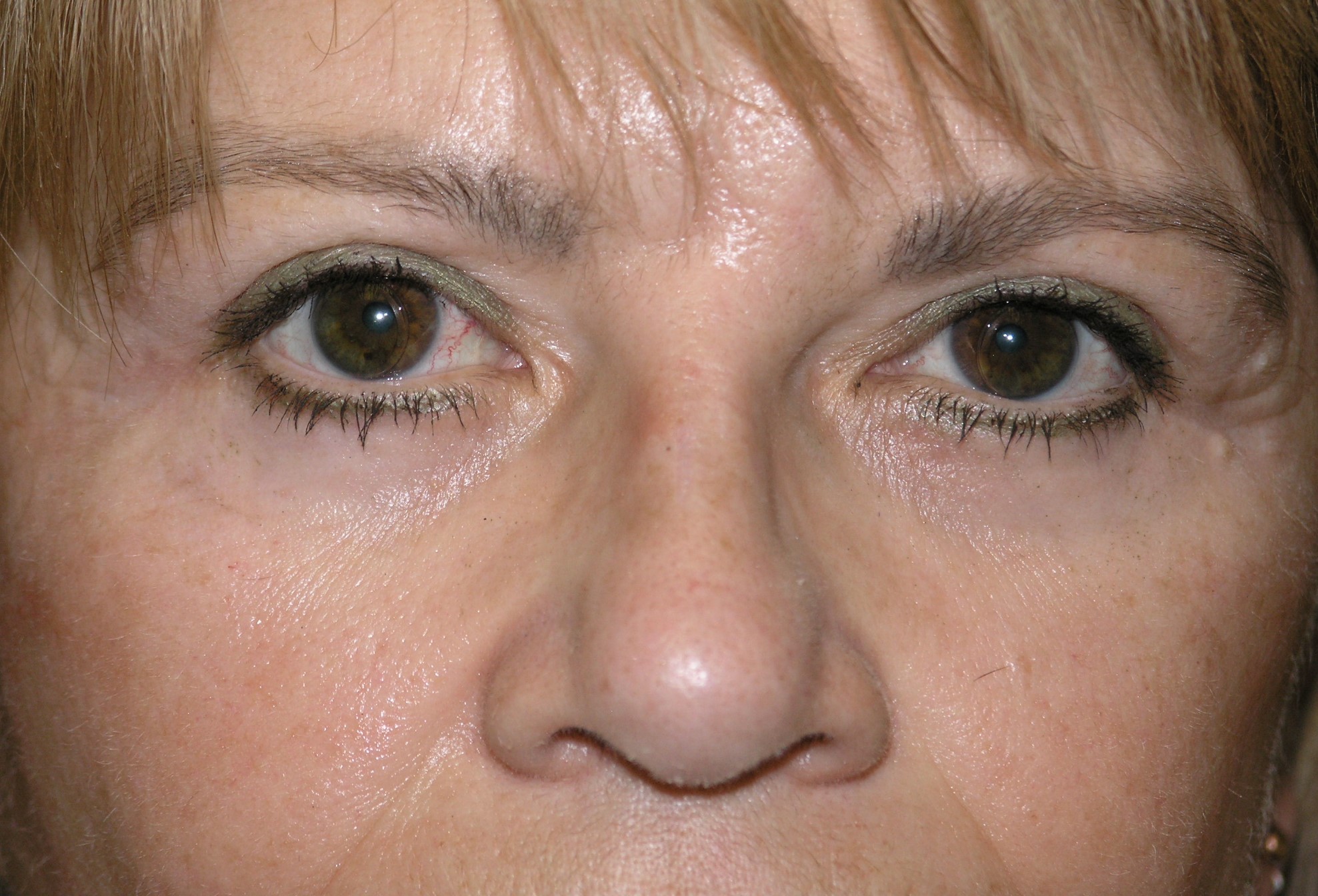Blepharoplasty Before & After Patient #1499