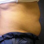 CoolSculpting Before & After Patient #1505