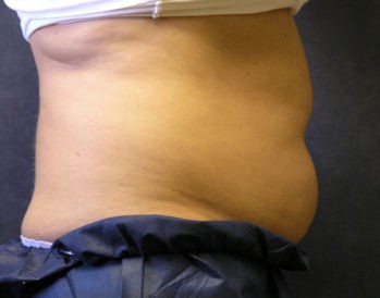 CoolSculpting Before & After Patient #1505
