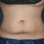 CoolSculpting Before & After Patient #1510