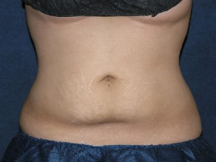 CoolSculpting Before & After Patient #1510