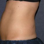 CoolSculpting Before & After Patient #1515