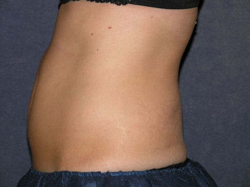 CoolSculpting Before & After Patient #1515
