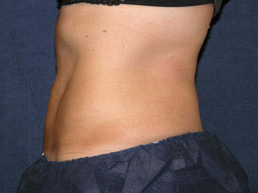 CoolSculpting Before & After Patient #1515