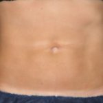 CoolSculpting Before & After Patient #1515