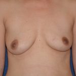 Breast Augmentation Before & After Patient #1534