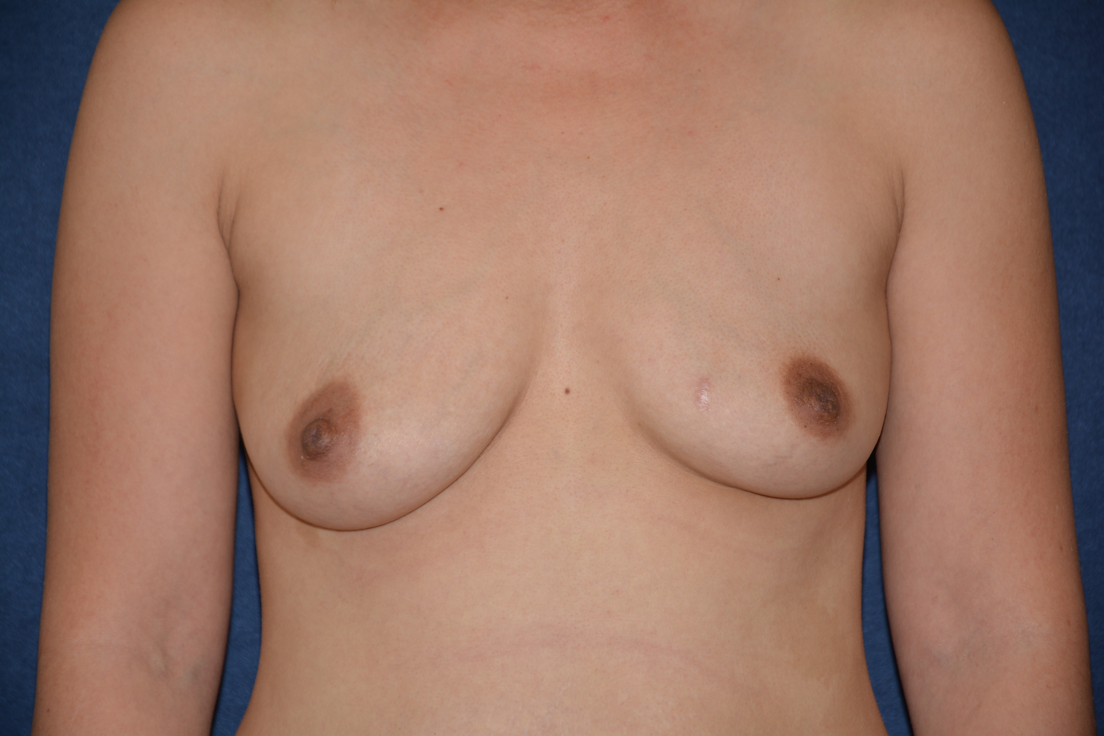 Breast Augmentation Before & After Patient #1534