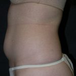 CoolSculpting Before & After Patient #1502