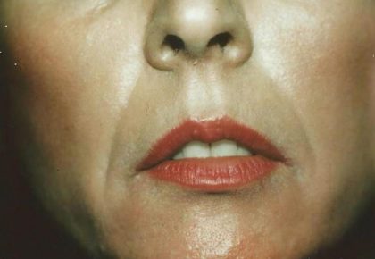 Derma fat Lip Augmentation Before & After Patient #1547