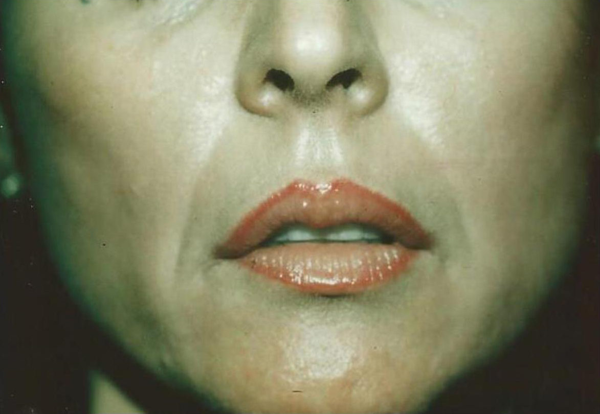 Derma fat Lip Augmentation Before & After Patient #1547