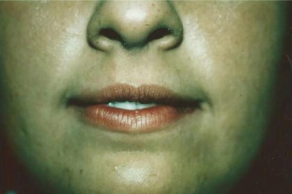 Derma fat Lip Augmentation Before & After Patient #1544