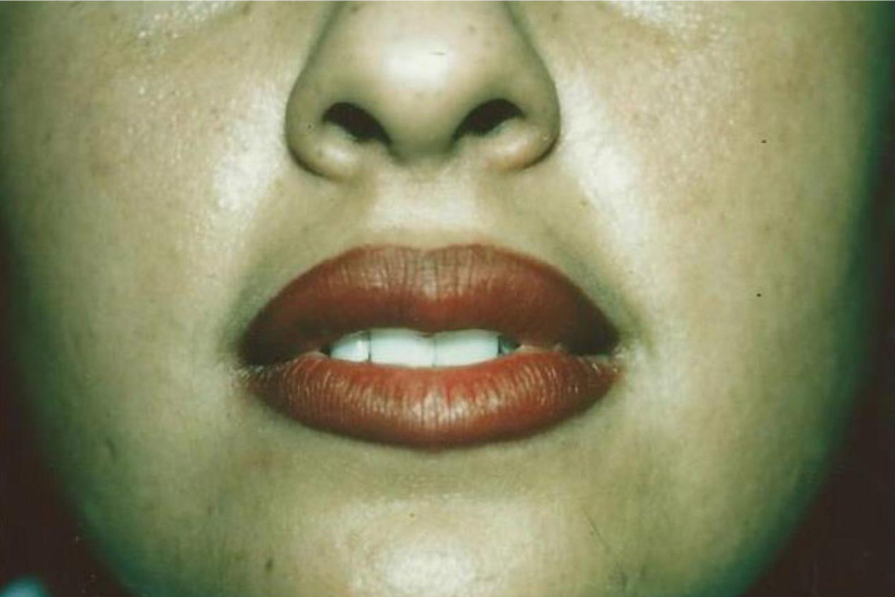 Derma fat Lip Augmentation Before & After Patient #1544