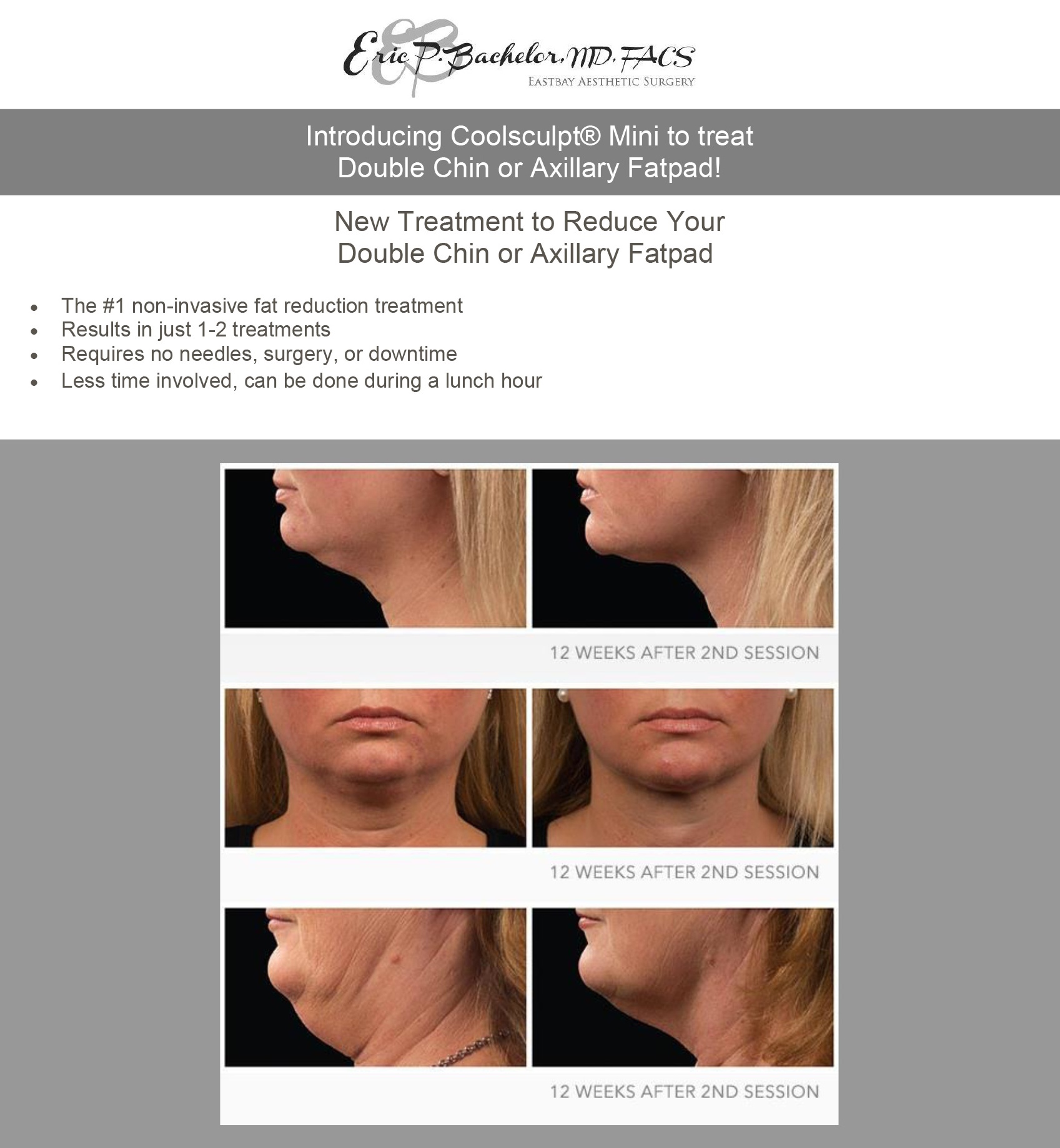 CoolSculpting in Pleasanton & Danville, CA