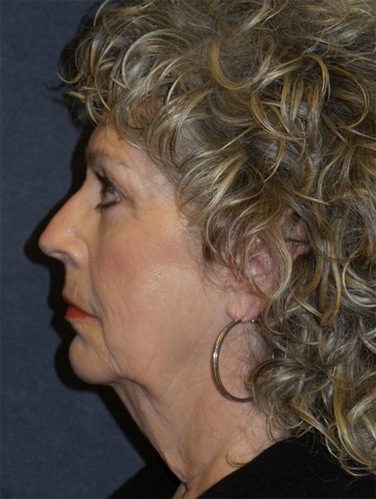 Facelift Before & After Patient #1712