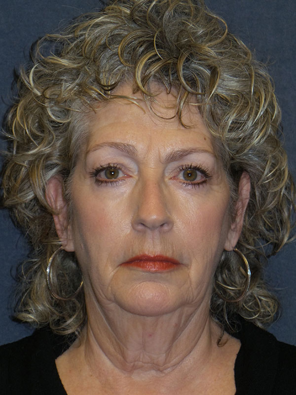Facelift Before & After Patient #1712