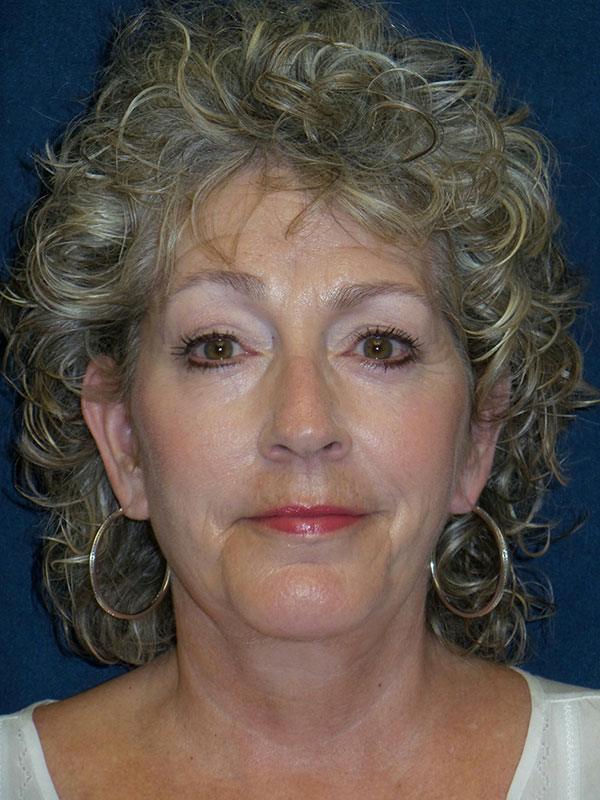 Facelift Before & After Patient #1712
