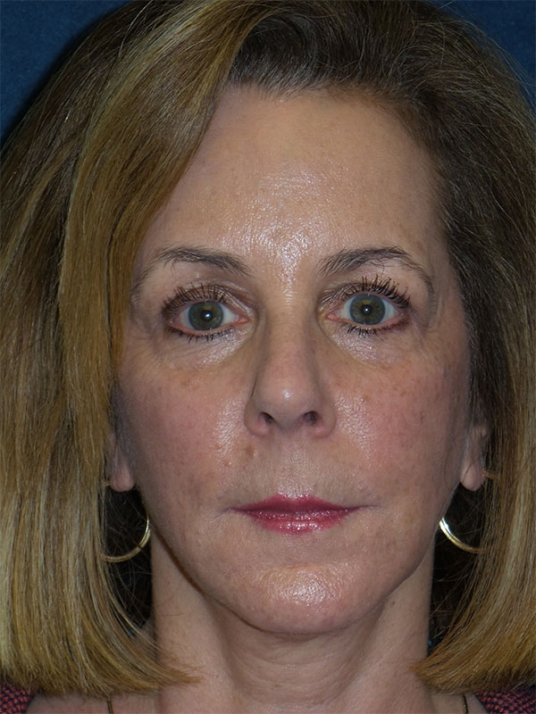Blepharoplasty Before & After Patient #1726