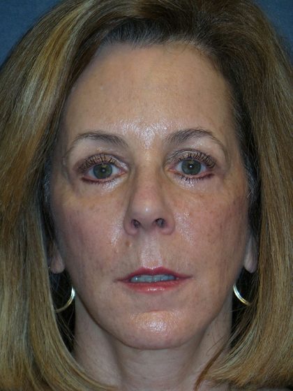 Blepharoplasty Before & After Patient #1726
