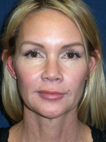 Mid Facelift Before & After Patient #1729