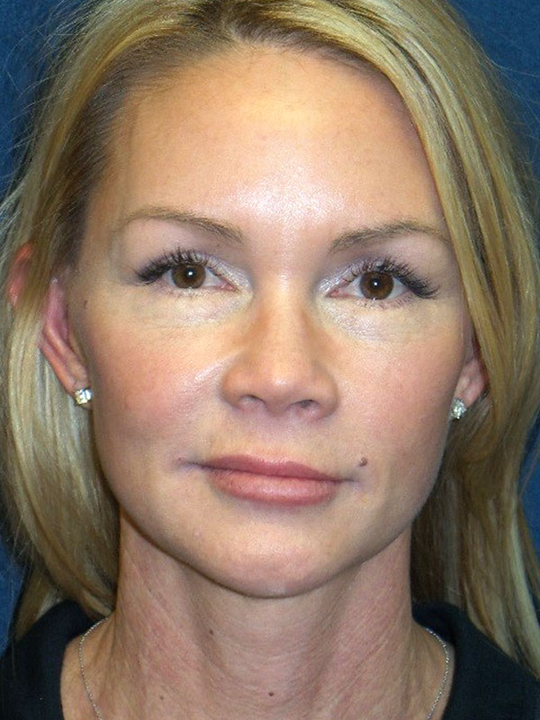 Mid Facelift Before & After Patient #1729
