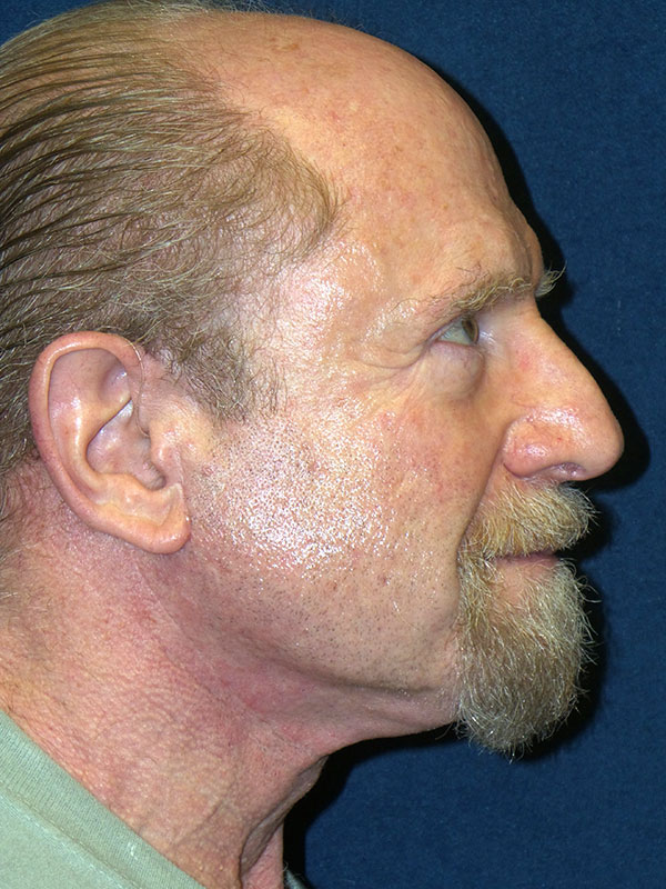 Neck Lift Before & After Patient #1735