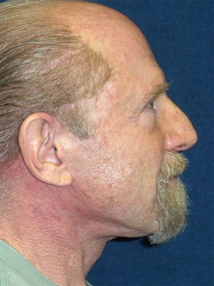 Neck Lift Before & After Patient #1735
