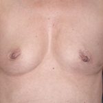 Breast Reconstruction Before & After Patient #1745