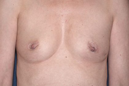 Breast Reconstruction Before & After Patient #1745