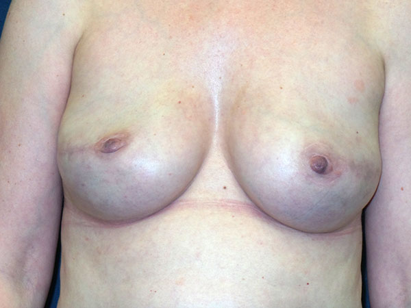 Breast Reconstruction Before & After Patient #1745