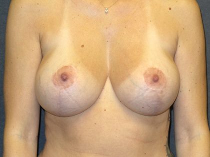 Breast Augmentation Before & After Patient #1748