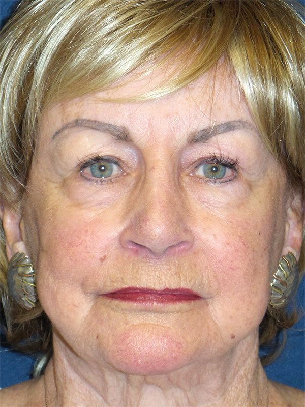 Facelift Before & After Patient #1755