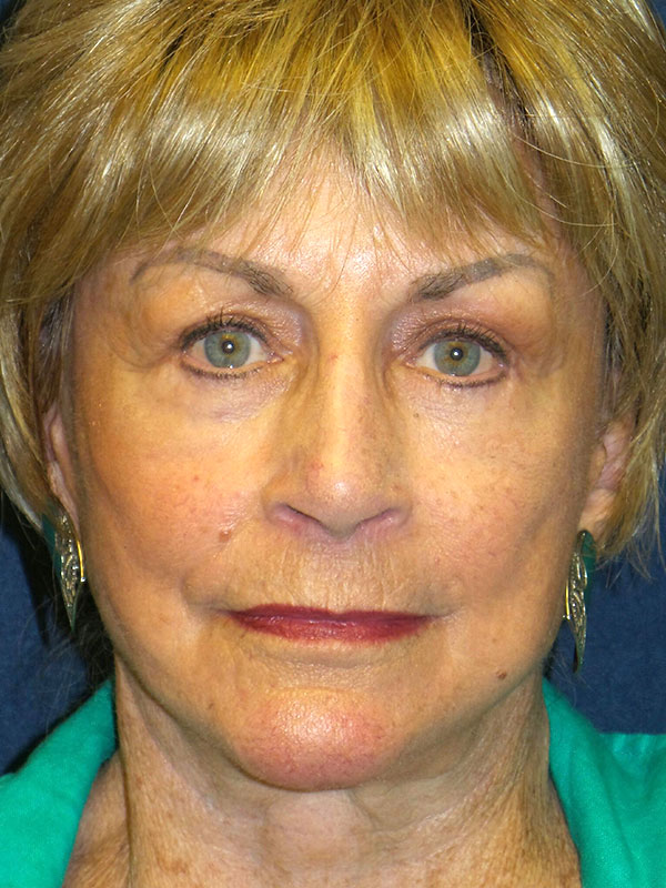 Facelift Before & After Patient #1755