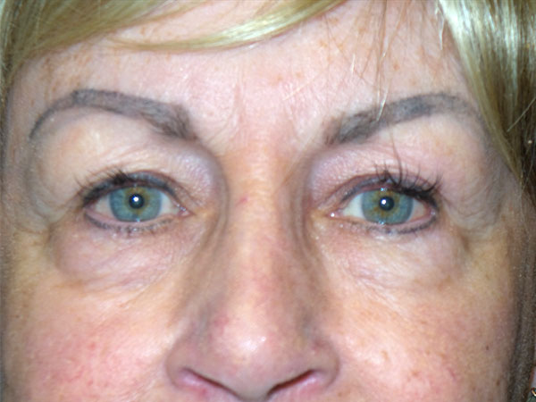 Blepharoplasty Before & After Patient #1760