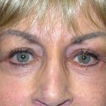 Blepharoplasty Before & After Patient #1760