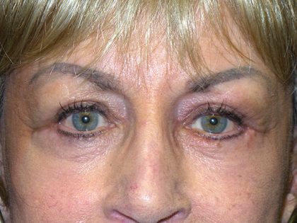 Blepharoplasty Before & After Patient #1760