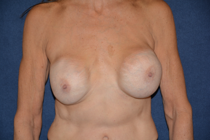 Breast Augmentation Before & After Patient #1696