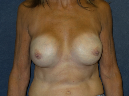 Breast Augmentation Before & After Patient #1696