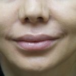 Derma fat Lip Augmentation Before & After Patient #1717