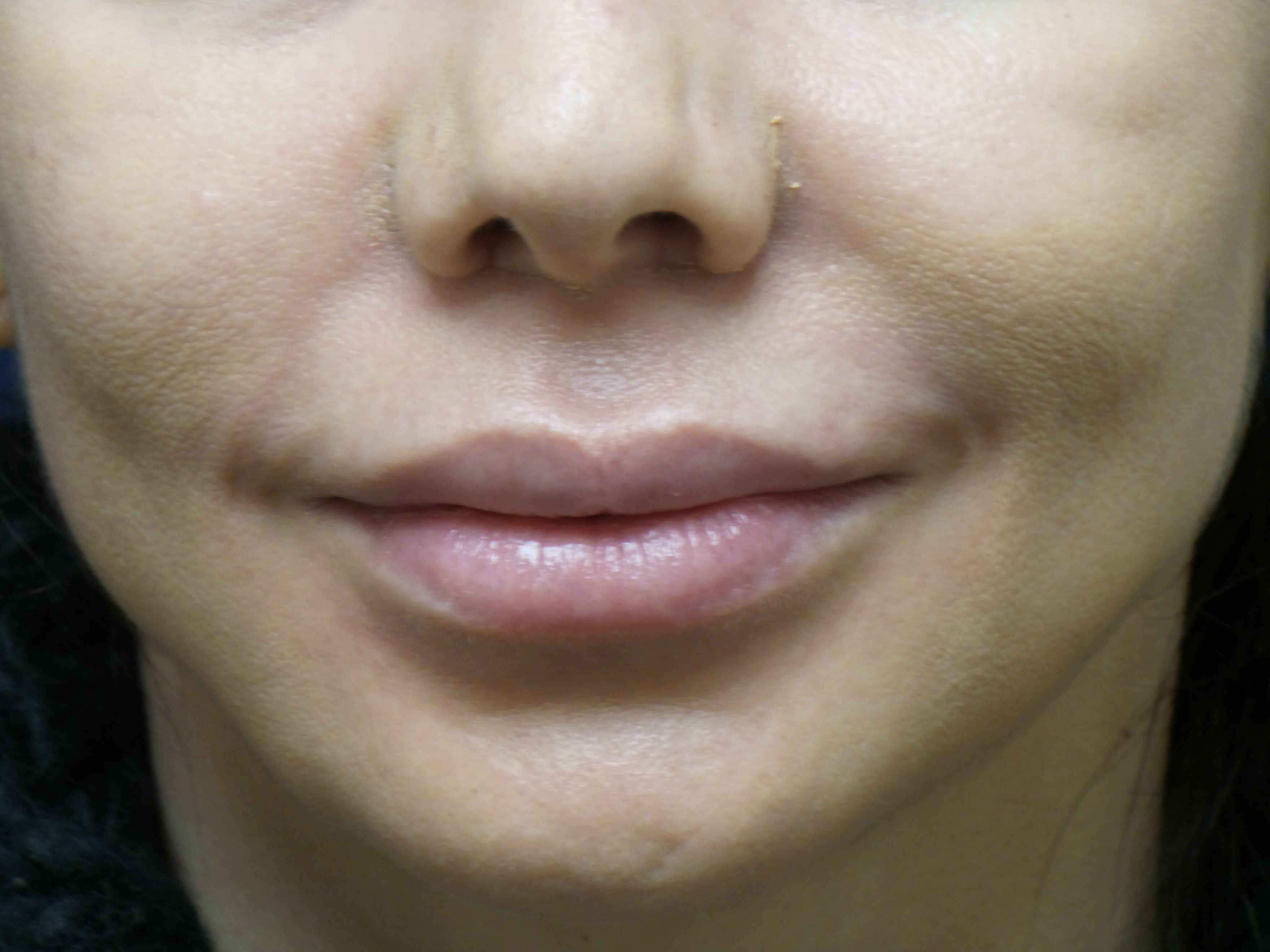 Derma fat Lip Augmentation Before & After Patient #1717