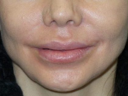 Derma fat Lip Augmentation Before & After Patient #1717