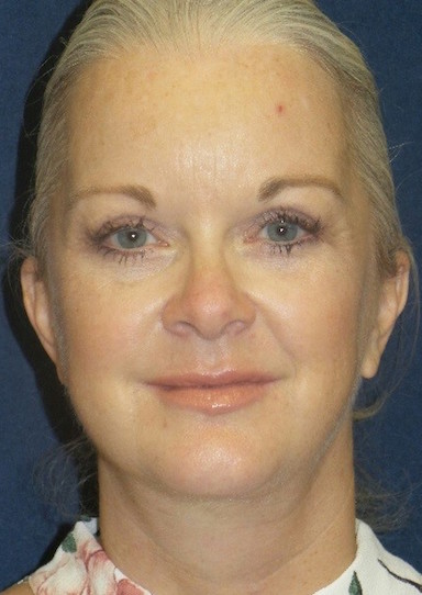 Blepharoplasty Before & After Patient #1781