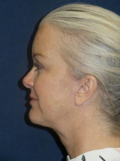 Blepharoplasty Before & After Patient #1781
