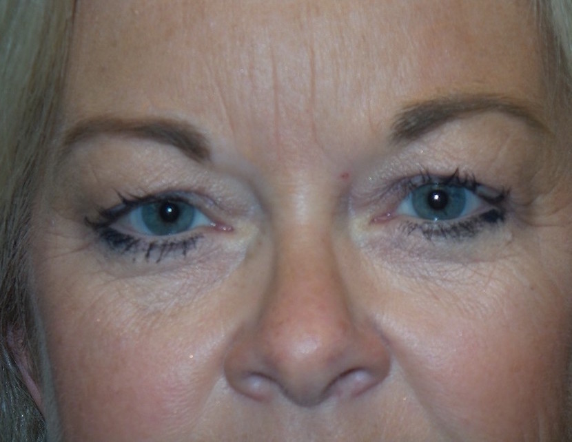Blepharoplasty Before & After Patient #1776