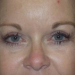 Blepharoplasty Before & After Patient #1776