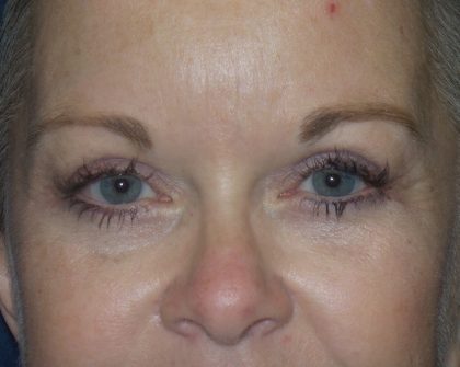 Blepharoplasty Before & After Patient #1776
