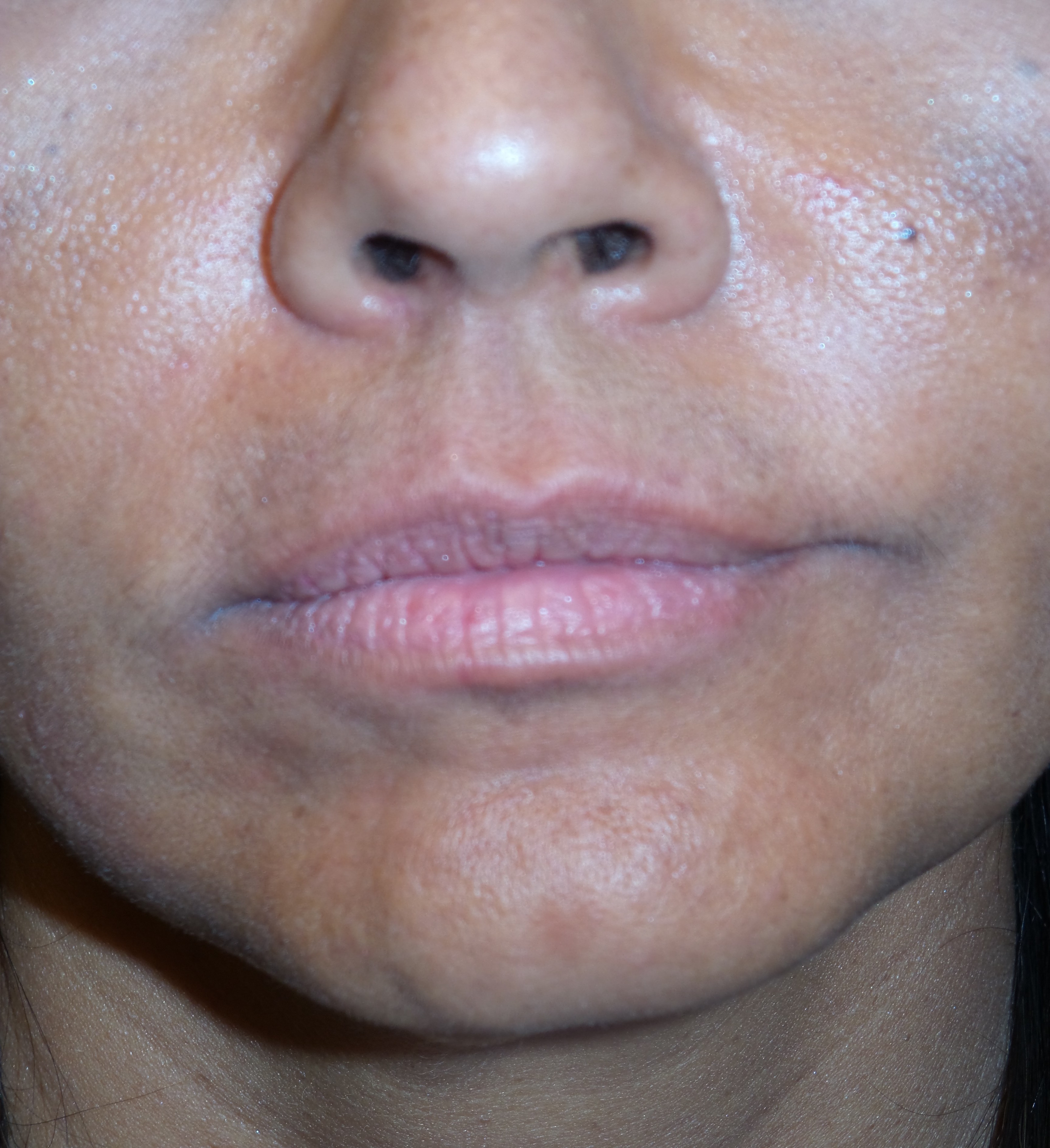 Dermal Fillers Before & After Patient #1798