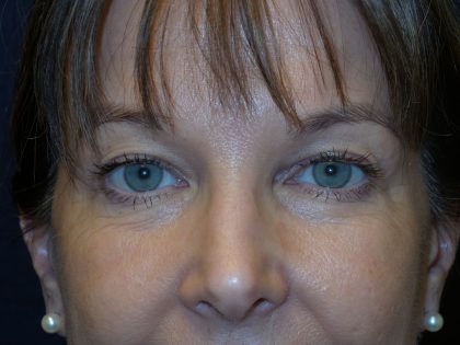 Brow Lift Before & After Patient #1820