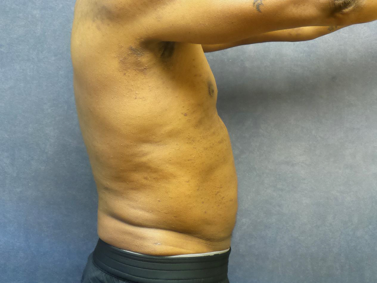Liposuction Before & After Patient #2126
